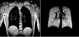SEE_THROUGH_LUNGS_65Y